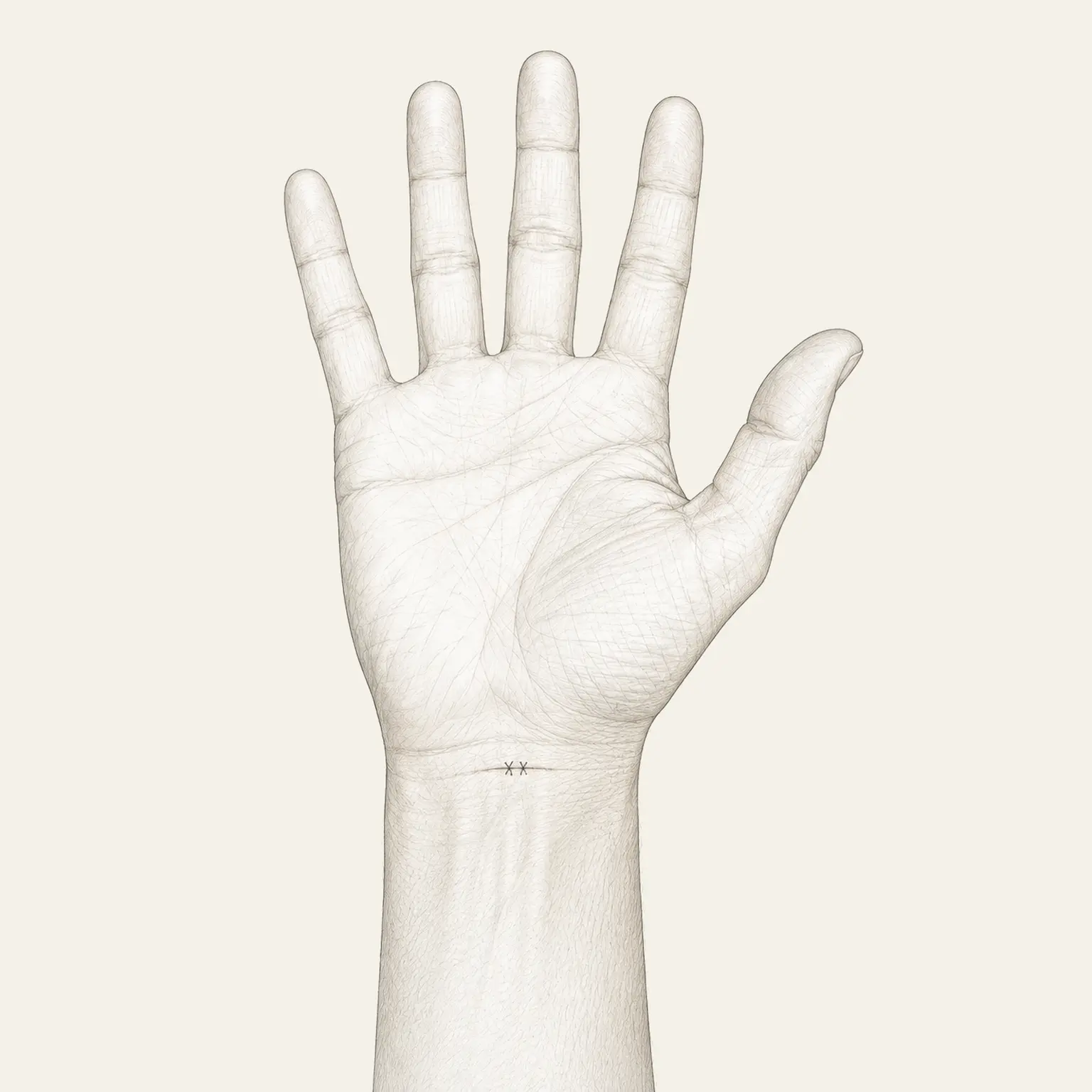 Localisation et taille de la mini-incision endoscopique