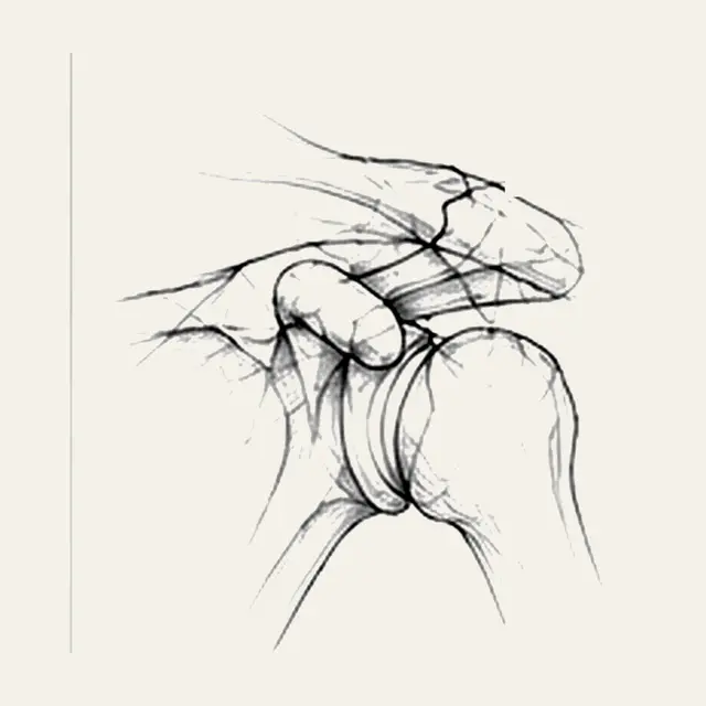 Arthrose acromio-claviculaire