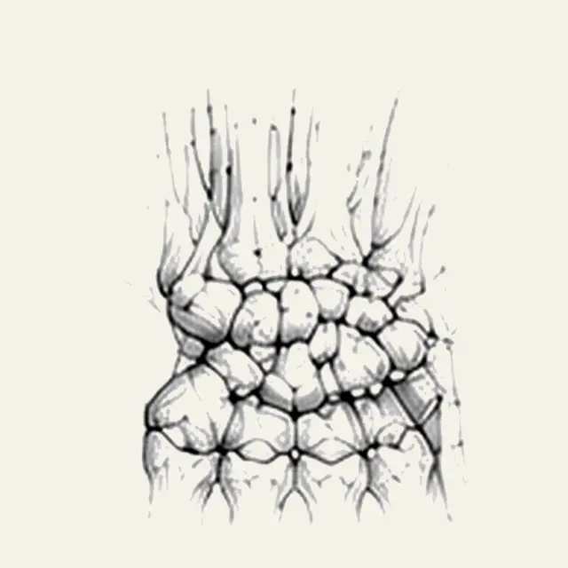 Arthrose du carpe