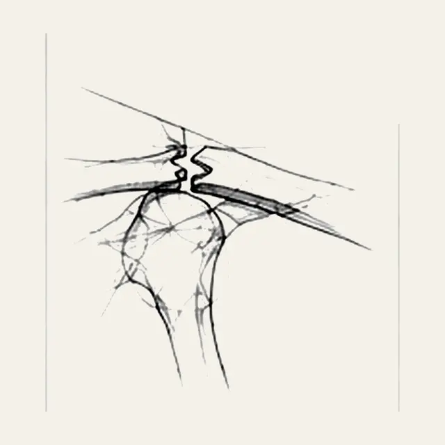 Fracture de clavicule