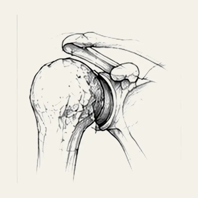 Omarthrose