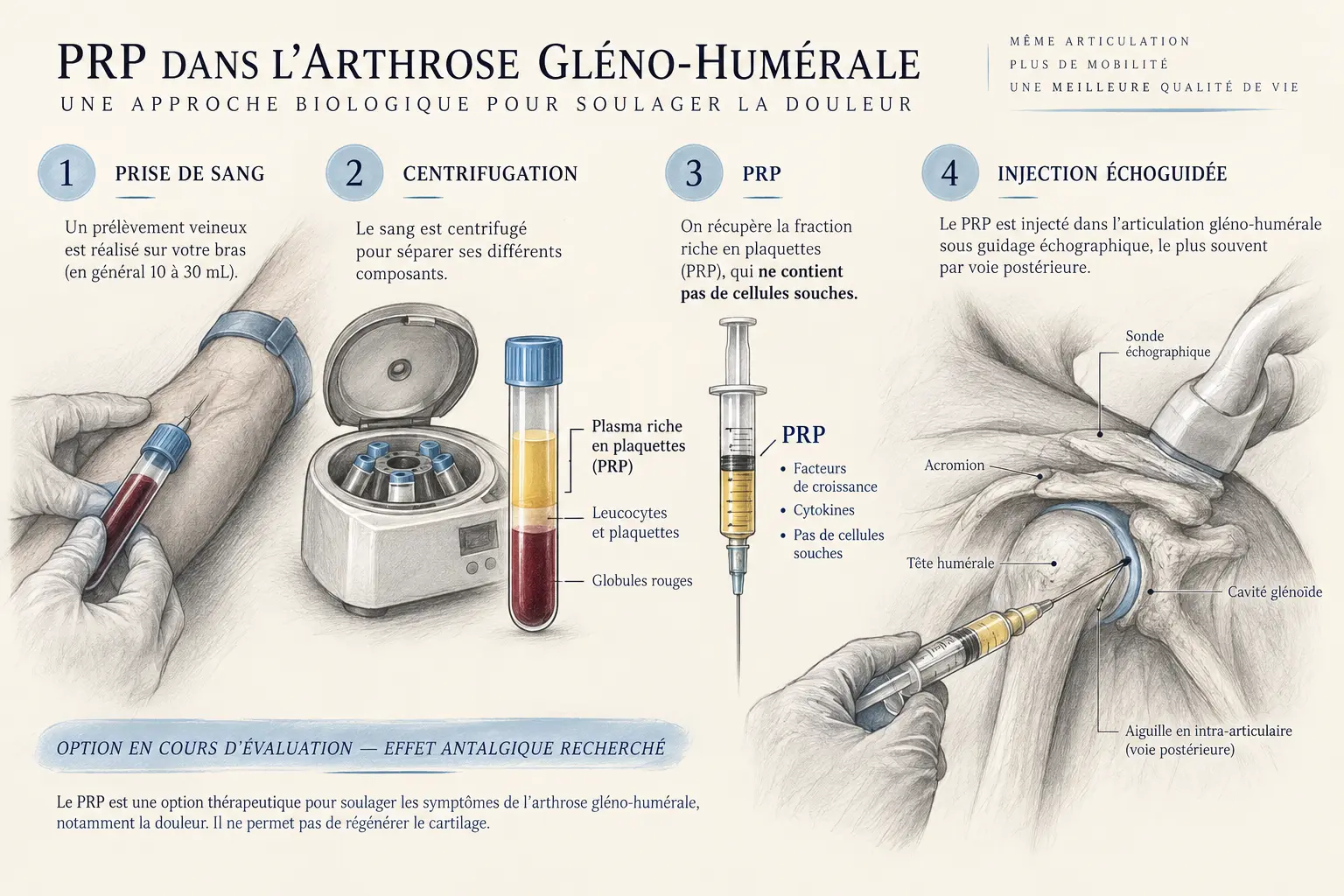 Prélèvement, centrifugation et injection échoguidée de PRP