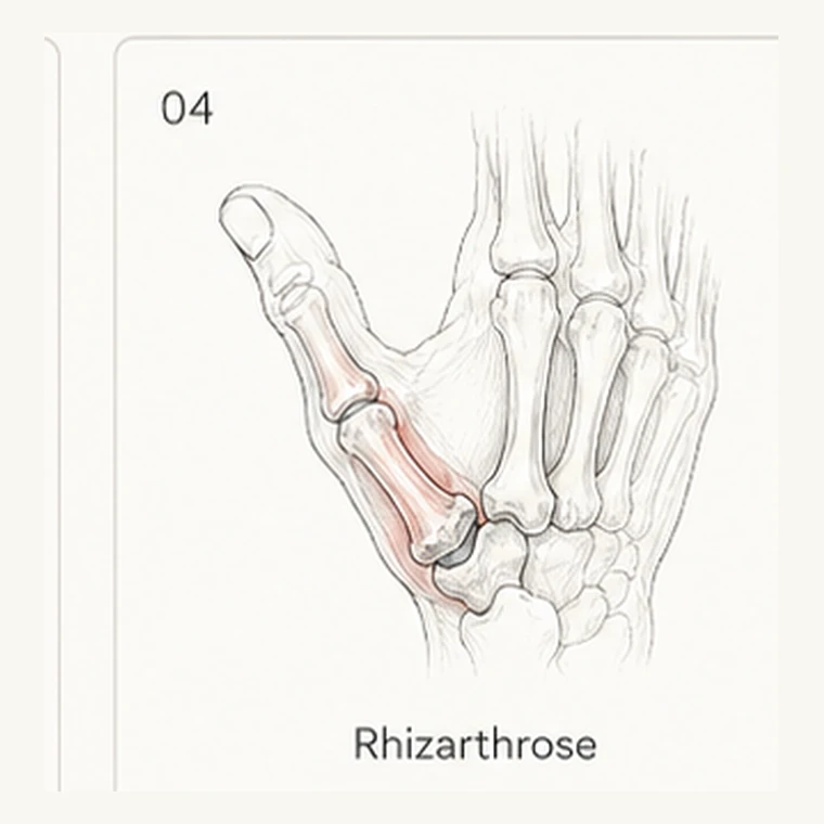 Rhizarthrose